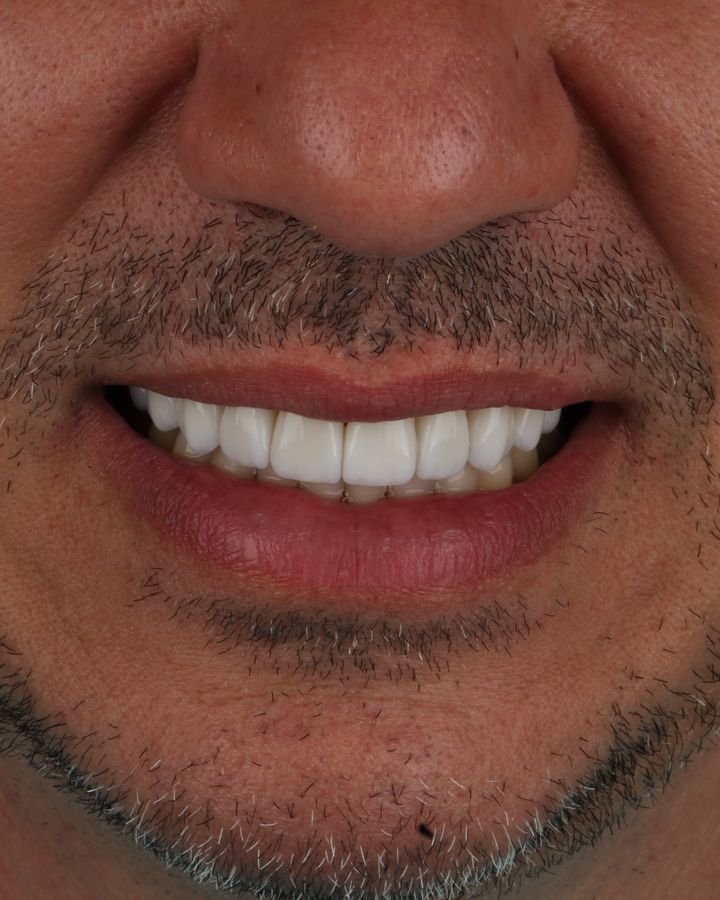 Depois, facetas finalizadas com brilho natural
